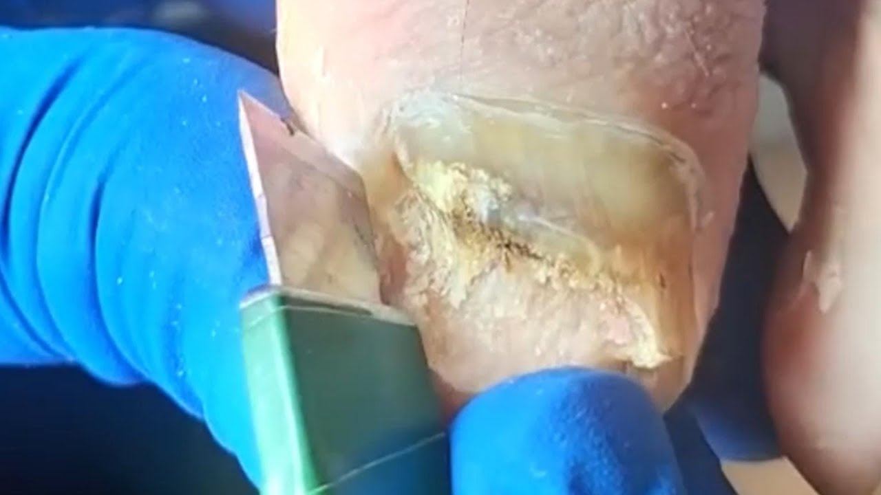 Thick nail fungus trimming deep cleaning of hard ingrown toenails FanYi