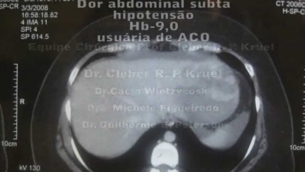 ADENOMA ROTO 1 смотреть онлайн