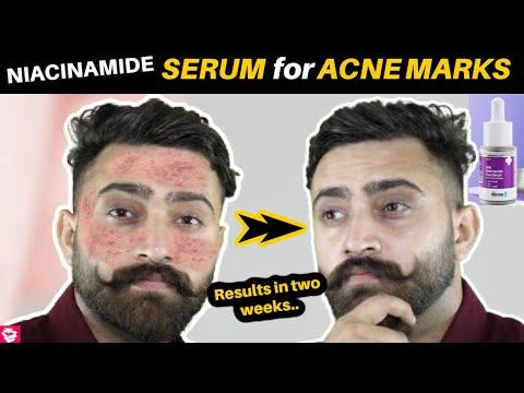 BEST FACE SERUM FOR ACNE MARKS? THE DERMA CO. 10% NIACINAMIDE FACE SERUM REVIEW | @QualityMantra смотреть онлайн