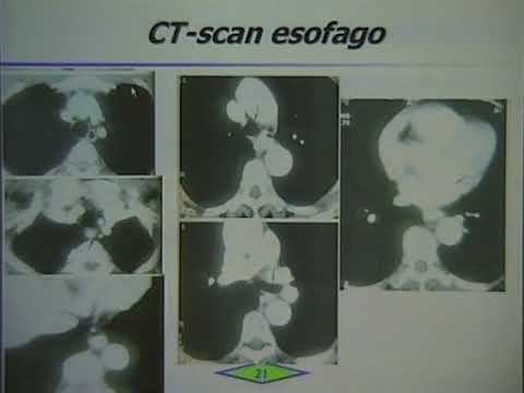 06 TSRM 3. Esofago, Stomaco e Duodeno. Cinzia Marenzi смотреть онлайн
