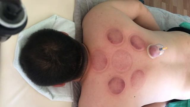 Хиджама, капиллярное кровопускание смотреть онлайн