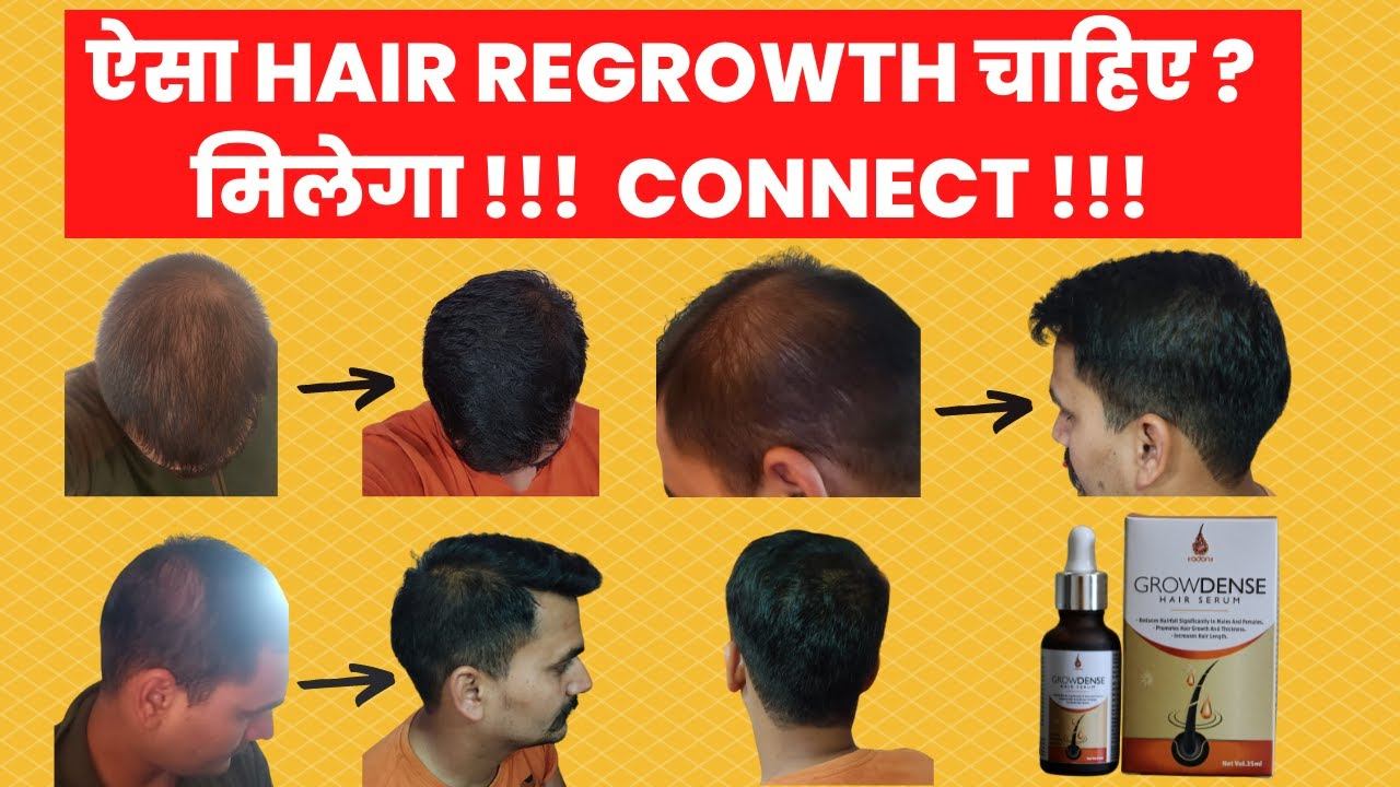 Best Hair Regrowth By Growdense Hair Serum- Dr. Ashok Sinha смотреть онлайн