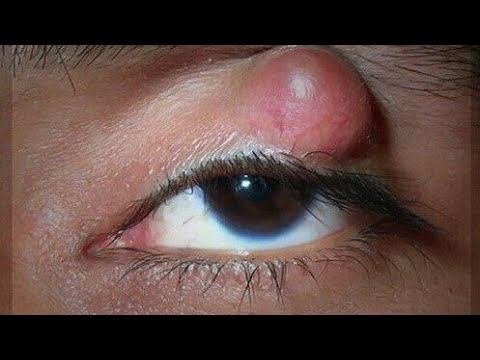 Removes Acne, Давим прыщи, чёрные точки. Залипательно 2021