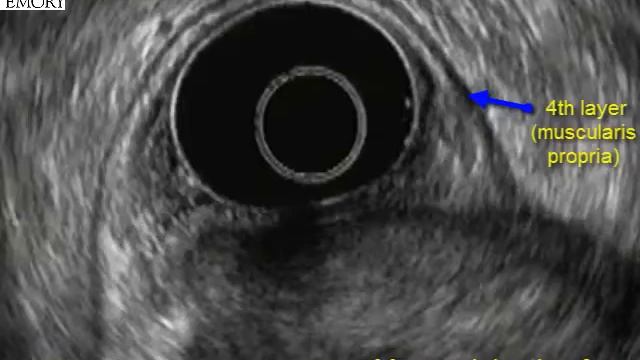 Gastric GIST смотреть онлайн