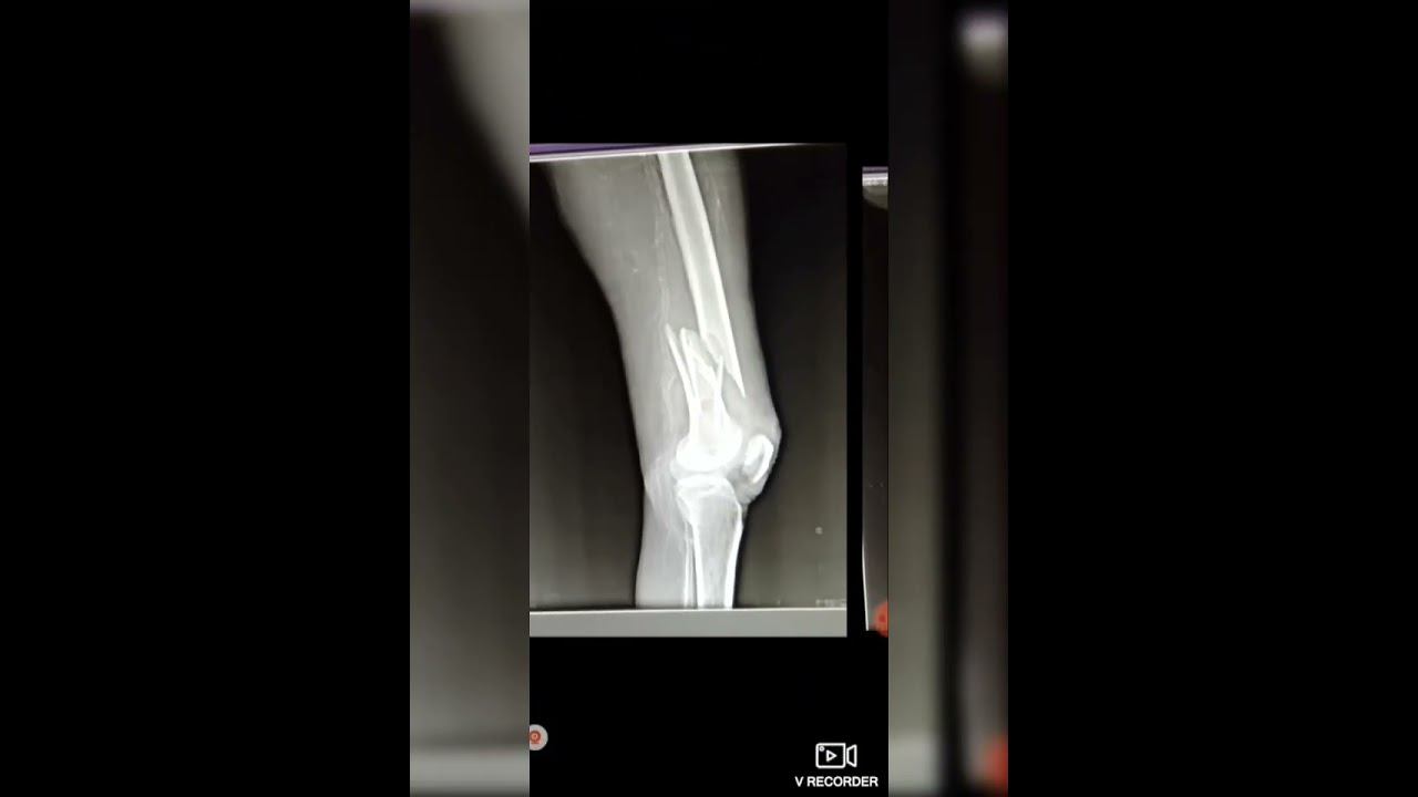 femur bone radiography 31/01/2023 смотреть онлайн