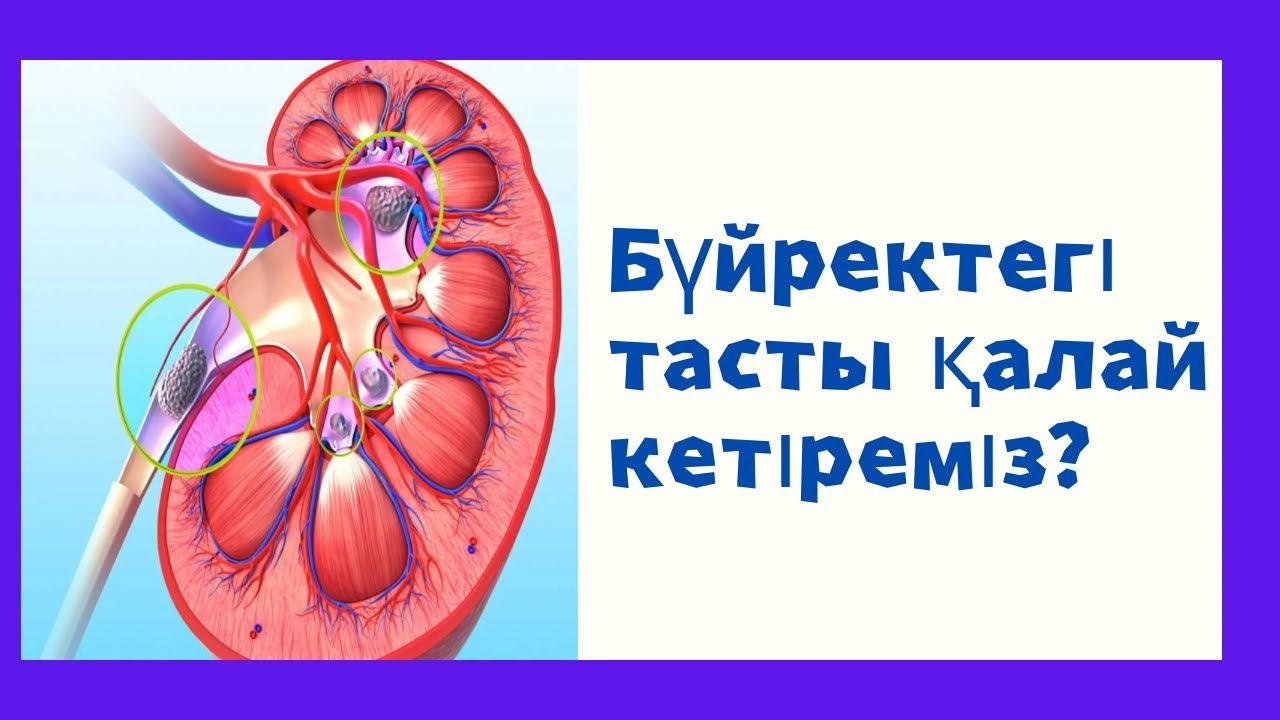 Бүйректегі тастар қайдан пайда болады? смотреть онлайн