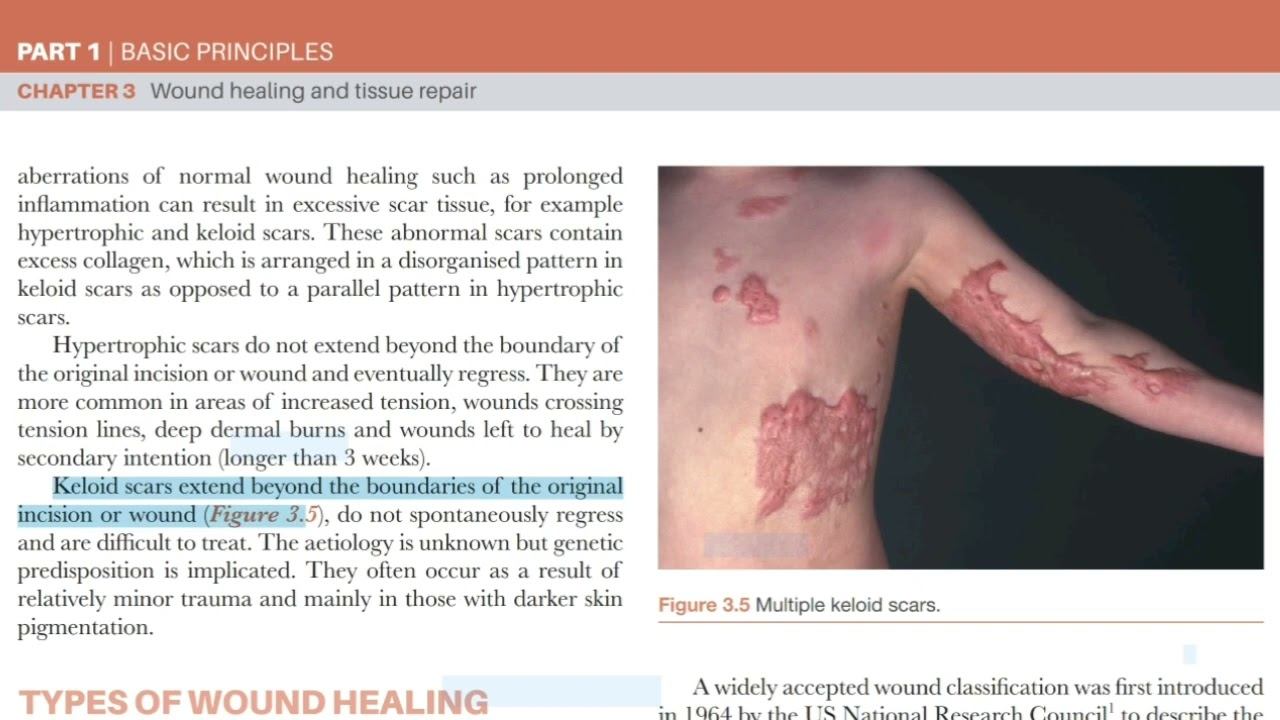 Wound Healing, Audio Topic, Bailey & Love Surgery, Audiobook, Surgeon Dr Muhammad Ayaz. смотреть онлайн
