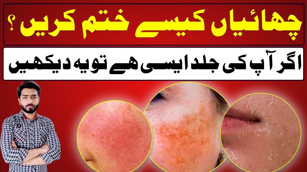 Pigmentation Removal Cream | چھائیاں کیسے ختم کریں | چہرے کی لالگی ختم کریں смотреть онлайн