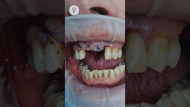 Восстановили костную ткань и поработали с мягкими тканями. Имплантация зубов. смотреть онлайн