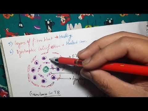 Tuberculosis Pathology смотреть онлайн