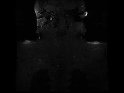 MRI of Brachial Plexus (CORT1 FS) Without SatPad™ By Clinical Image Solutions смотреть онлайн