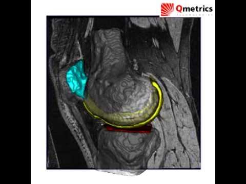 Transforming an MRI into a 3D Model смотреть онлайн