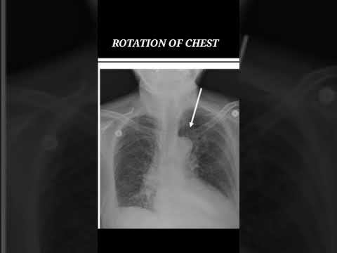 ROTATION OF CHEST || HINDI || смотреть онлайн