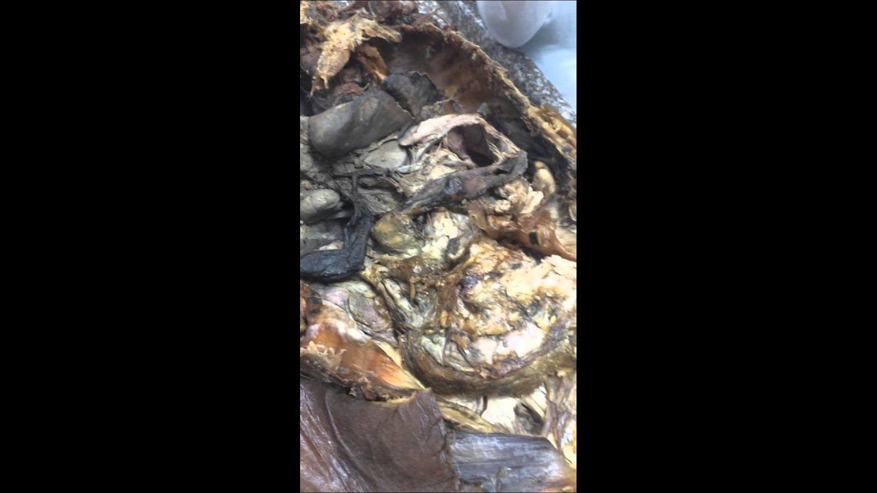 TRONCO CELIACO PRIMERA PARTE смотреть онлайн