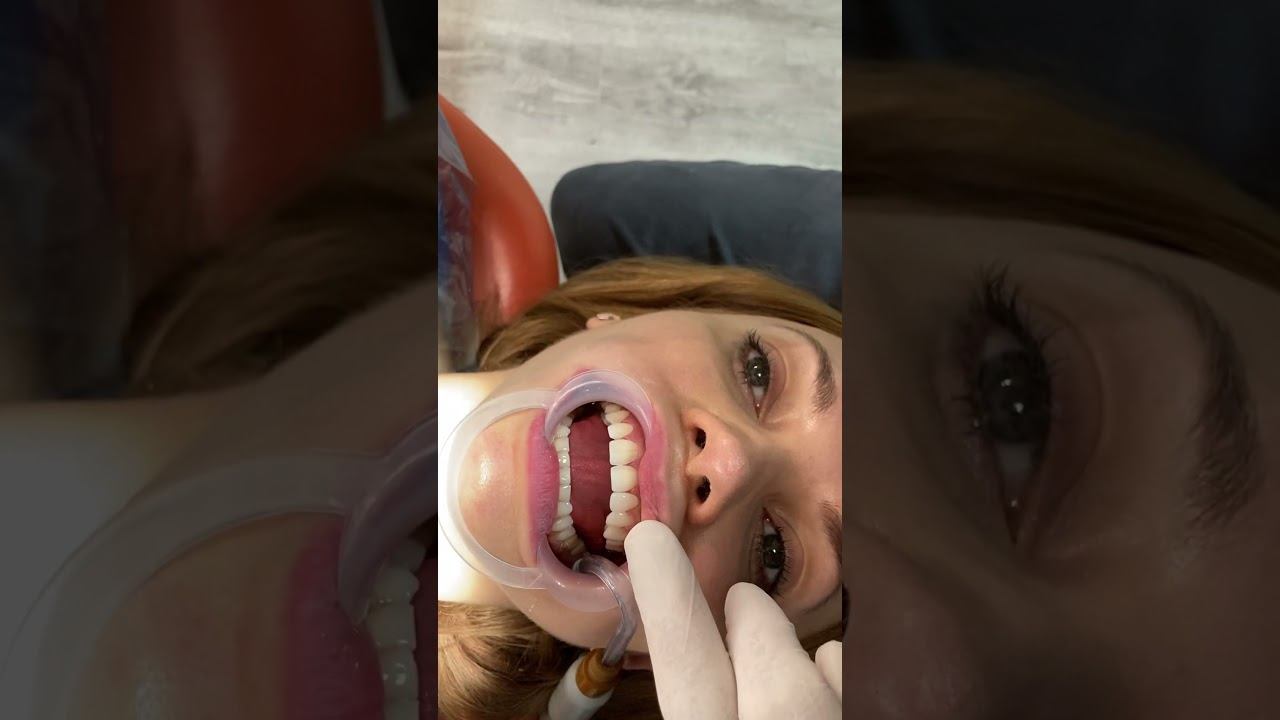 Dental Venner and Dental Lumineer without shaving teeth смотреть онлайн