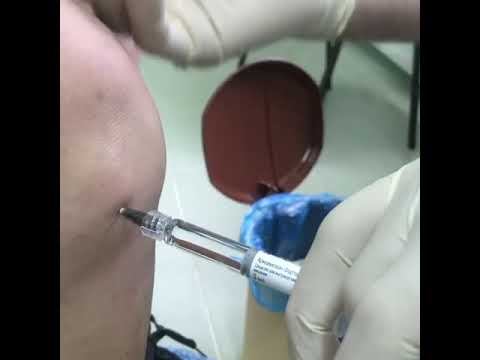 Деформирующий гонартроз 3 степени. смотреть онлайн