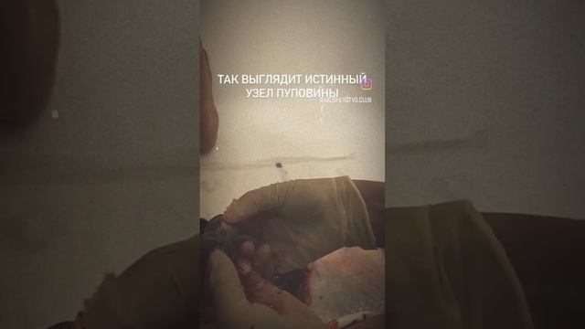 Истинный узел #акушерствоклуб #мягкиероды #родыбезболи #родысдоулой #акушерка #партнерскиероды #род смотреть онлайн