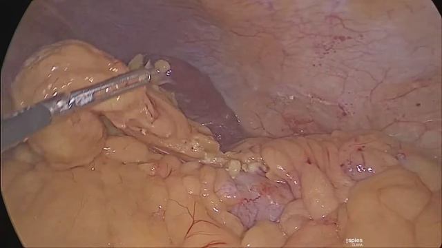 Лапароскопическая левсторонняя гемиколэктомия смотреть онлайн