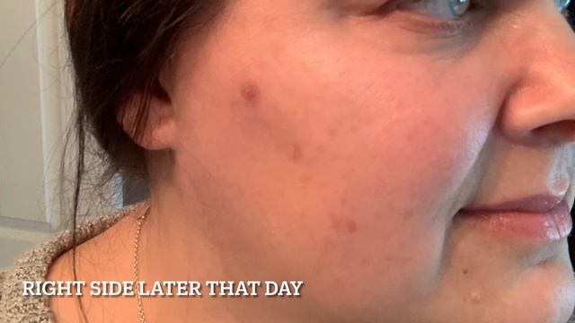 CRYO FREEZE, Getting rid of dark marks!! Does this work?? Liquid nitrogen. смотреть онлайн