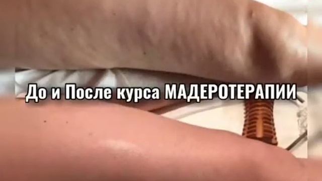 До и После. Мадеротерапия. смотреть онлайн