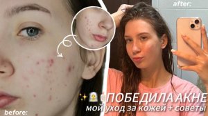 я ПОБЕДИЛА АКНЕ без похода к врачу| мои секреты чистой кожи 🥗🤫