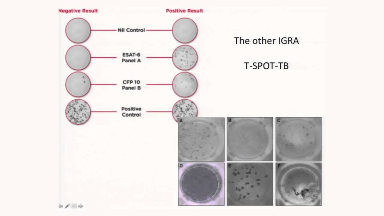 Laboratory Evaluation of Immunity to Mycobacterium Tuberculosis in Humans смотреть онлайн