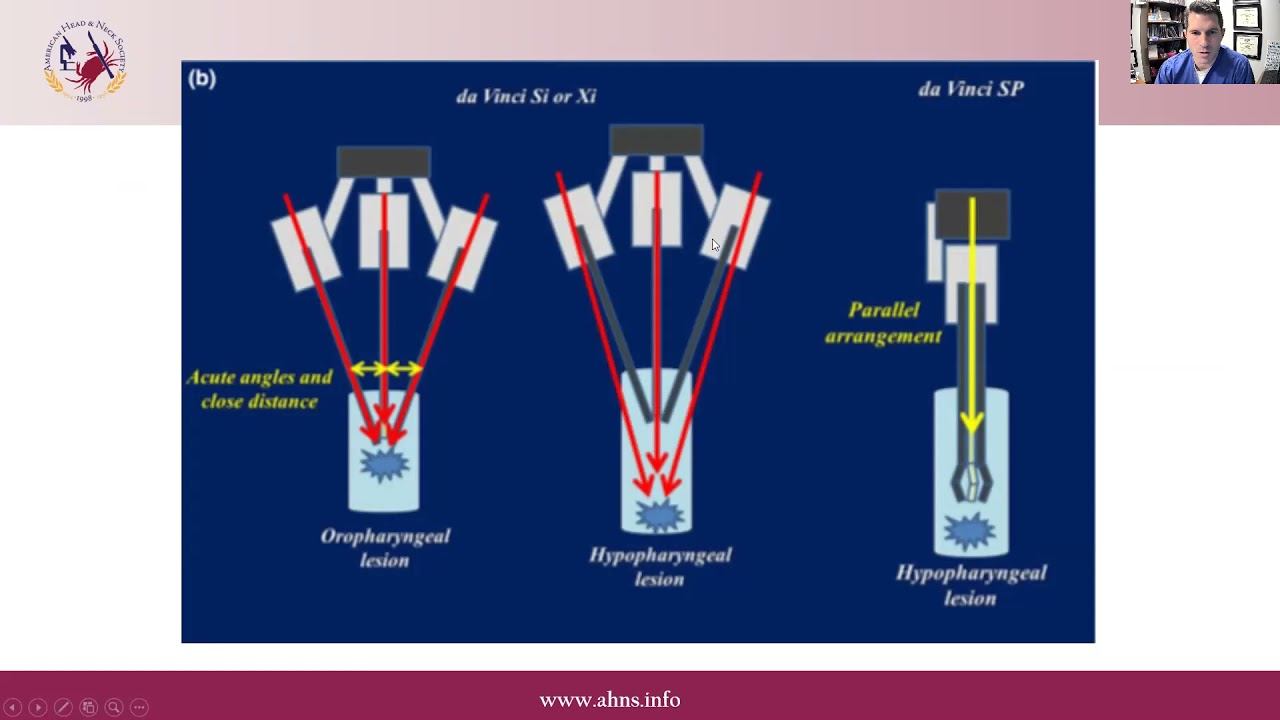 TORS for Larynx and Hypopharynx смотреть онлайн