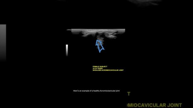 #ultrasound Guided Interventions: Healthy Images (Acromioclavicular Joint) смотреть онлайн