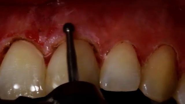 Innovative technique by Dr. Maxim Baini for Aesthetic Crown Lengthening flapless смотреть онлайн