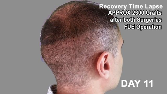 Hair Transplant Review 2013 19 DAY RECOVERY TIME LAPSE OF DONOR AREA POST OP смотреть онлайн