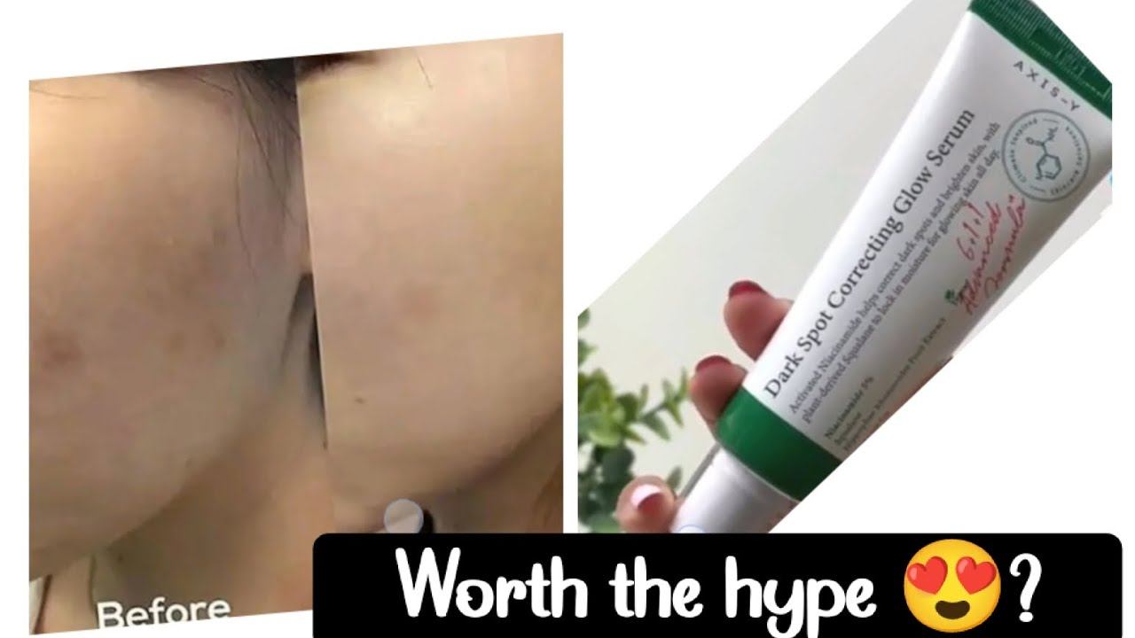 axis y dark spot correcting glow serum review in tamil #acnescars #scars смотреть онлайн