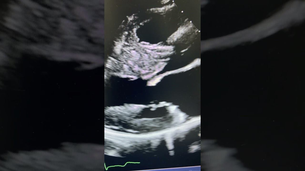 Marked and asymmetrical septal hypertrophy смотреть онлайн