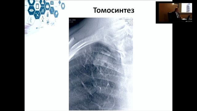 ПРОМЕНЕВА ДІАГНОСТИКА ТУБЕРКУЛЬОЗУ ОРГАНІВ ДИХАННЯ У ДІТЕЙ смотреть онлайн