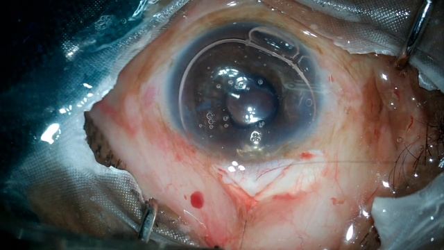 Combined Intra Tunnel Phacofracture SICS With Trabeculectomy With Removable Sutures (Unedited)HD смотреть онлайн