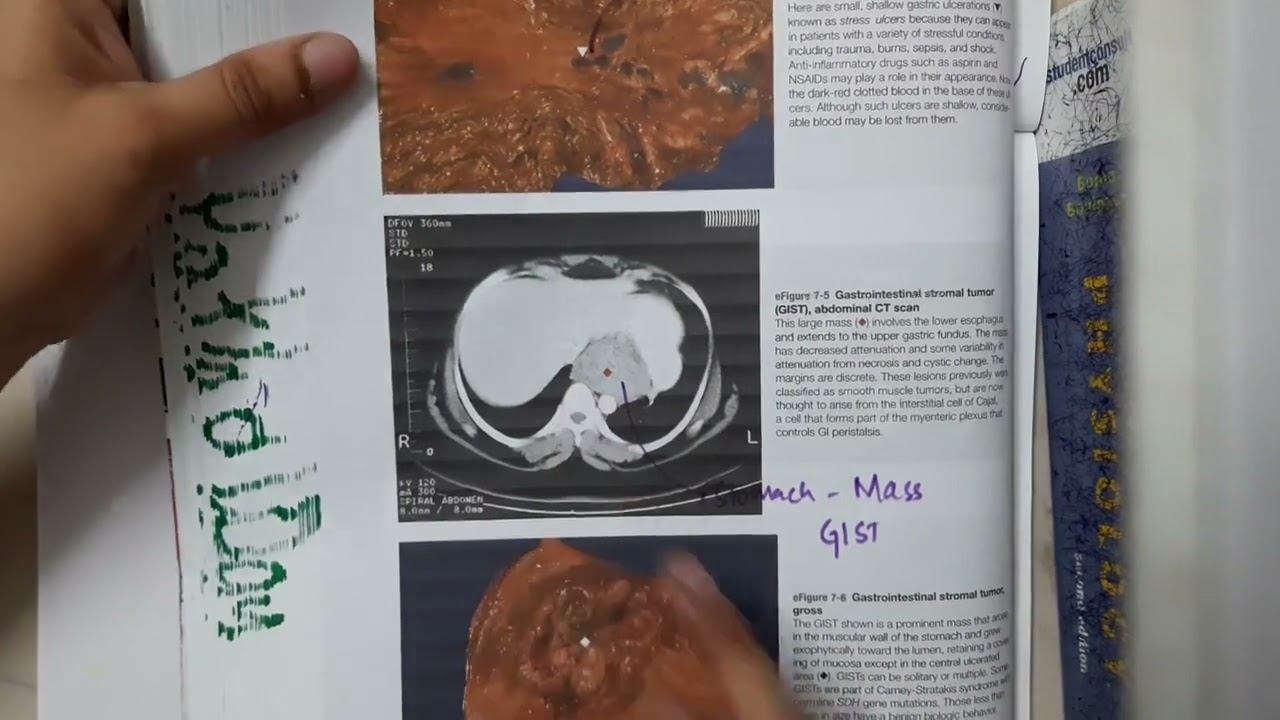 GastroIntestinal Stromal Disease mp4 смотреть онлайн