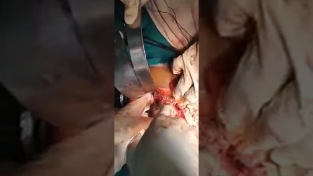 Radical cholecystectomy 2 Liver resection segment 4a &5 смотреть онлайн