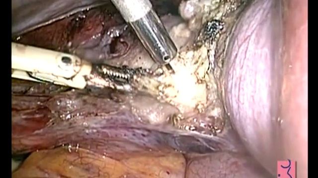 HT por laparoscopia con laser Diodo HP смотреть онлайн