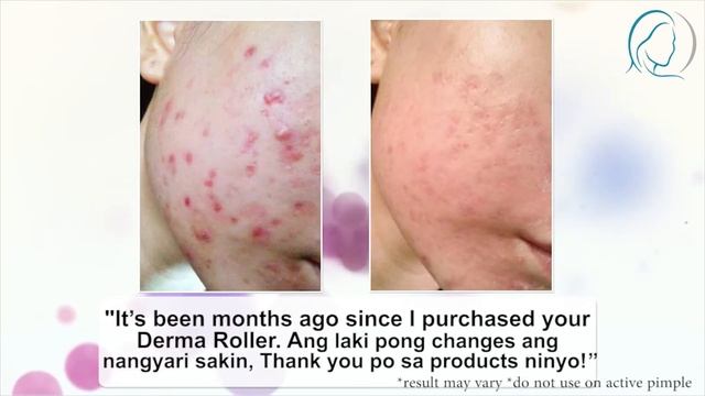 ANO NGA BA ANG DERMA ROLLER? | Derma Roller Philippines смотреть онлайн