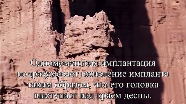 Одномоментная имплантация особенности и преимущества — Статья смотреть онлайн