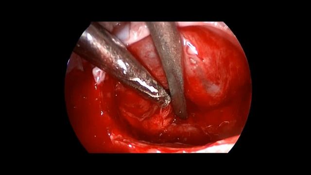 Endoscopic Endonasal Pituitary Macroadenoma Surgery - Updated Version Available смотреть онлайн