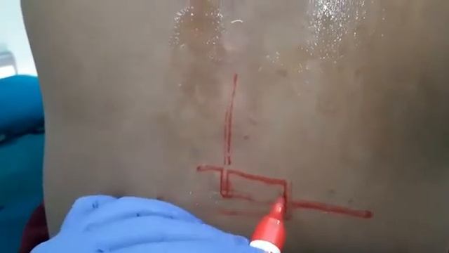 Ultrasound Assisted Thoracic Epidural смотреть онлайн