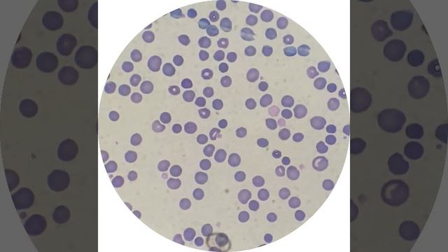 Blood smear with Large Platelets. смотреть онлайн