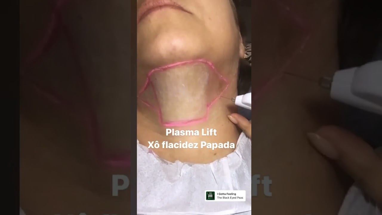 💎 Tratamento para Flacidez de Papada e Pescoço. #cris_santini смотреть онлайн
