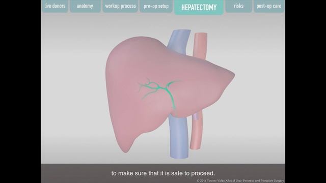 Living Donor Right Hepatectomy Procedure смотреть онлайн