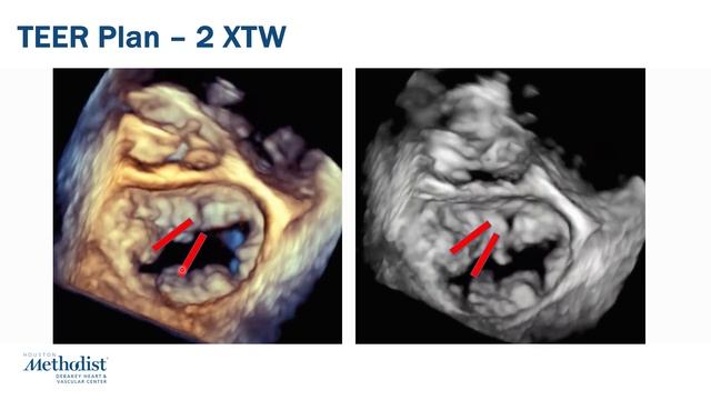 Structural Heart Intervention Series: TEER in Multi-Segment Disease (Sachin Goel, MD) смотреть онлайн