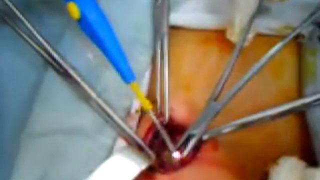 Parathroid Adenoma;parathyroidectomy by Prof.Dr.Alaa El Erian(no.3) смотреть онлайн