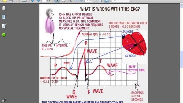 SESSIONS FOR NURSES 16 - EKG INTERPRETATION (Part 1 of 3) смотреть онлайн