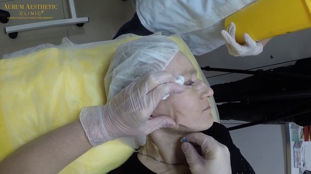 Mezonitě, liftující 3D kanylové nitě смотреть онлайн