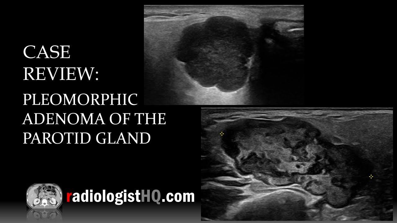 Ultrasound of Pleomorphic Adenoma of the Parotid Gland смотреть онлайн