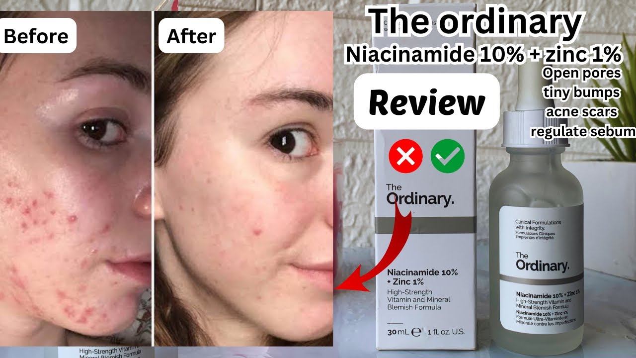 The ordinary niacinamide 10% + zinc 1 % serum review смотреть онлайн